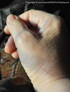 healing cat bite on base of senior woman's thumb