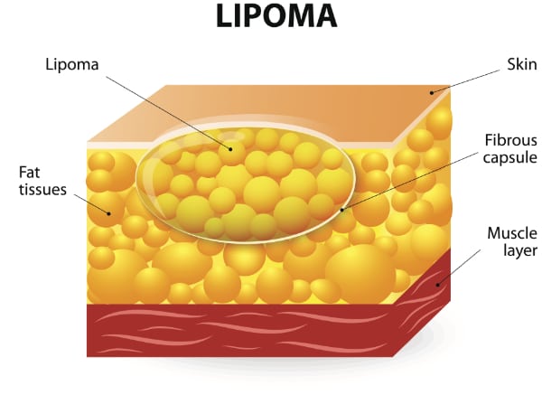 illustration of lipoma under skin